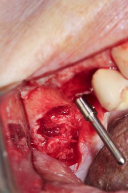 Azı dişleri cerrahi işlem. Dental Implant