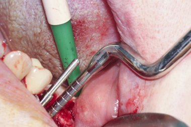 Azı dişleri cerrahi işlem. Dental Implant