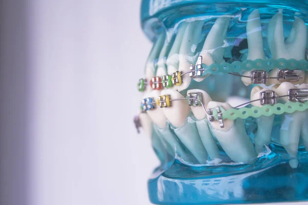Klassiska dental metall Ortodonti med färgade krokar — Stockfoto