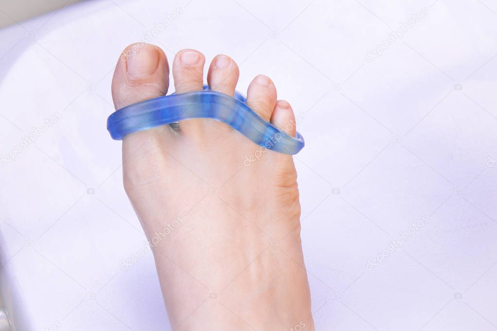 Foot of woman with silicone prosthesis to separate the toes