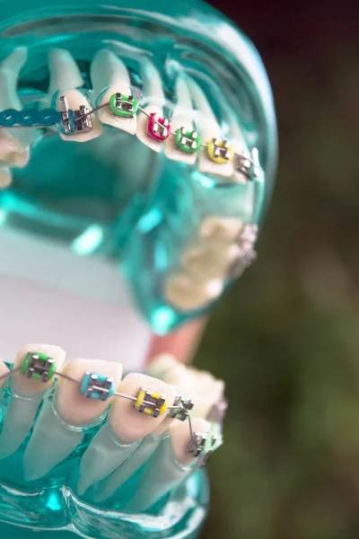 Klasyczne stomatologicznej ortodoncji metalowe z rożków — Zdjęcie stockowe