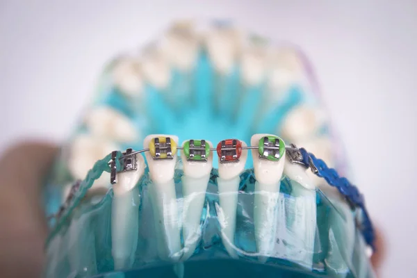 Klasyczne stomatologicznej ortodoncji metalowe z rożków — Zdjęcie stockowe