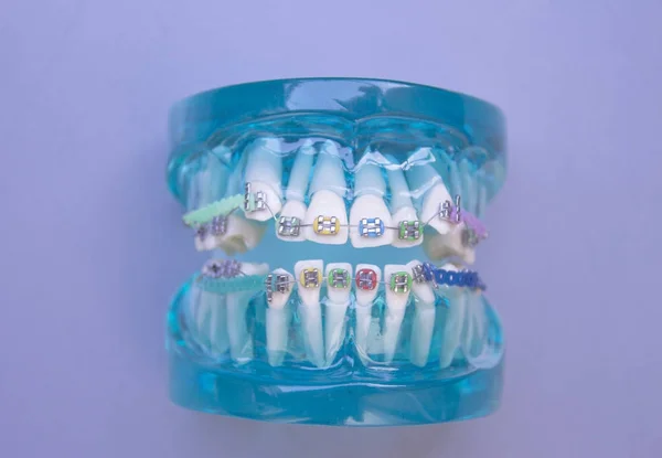 Ortodonzia classica in metallo dentale con ganci colorati — Foto Stock
