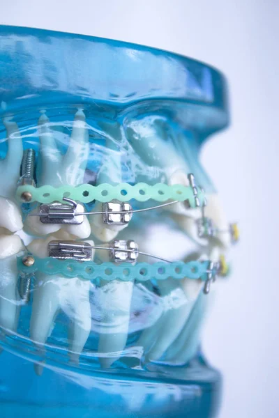 Classic dental metal orthodontics with colored hooks — Stock Photo, Image