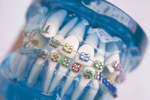 Ortodoncia metálica dental clásica con ganchos de colores —  Fotos de Stock