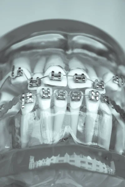 Ortodoncia metálica dental clásica con ganchos de colores — Foto de Stock