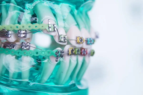Ortodoncia metálica dental clásica con ganchos de colores —  Fotos de Stock