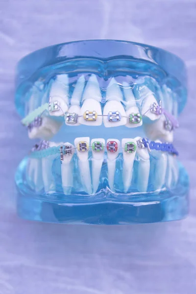 Ortodoncia metálica dental clásica con ganchos de colores —  Fotos de Stock