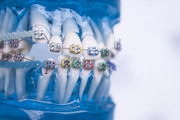 Ortodontia de metal dental clássico com ganchos coloridos — Fotografia de Stock