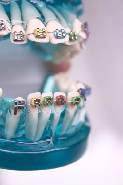 Ortodoncia metálica dental clásica con ganchos de colores —  Fotos de Stock