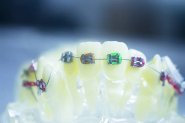 Metal ortodontikli protez. Kimse yok.