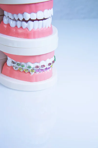 Modelo Prótesis Dental Con Ortodoncia Metálica Hay Gente — Foto de Stock