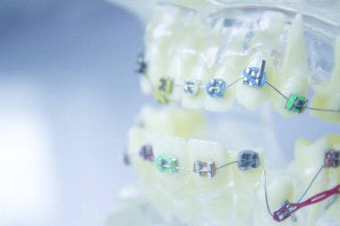 Metal ortodontikli protez. Kimse yok.