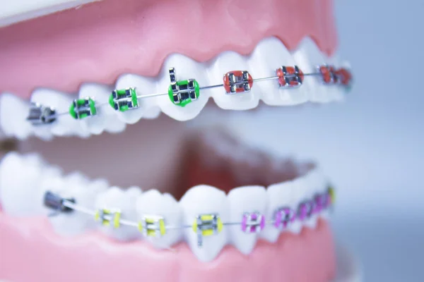 Modèle Prothèse Dentaire Avec Orthodontie Métallique Pas Peuple — Photo