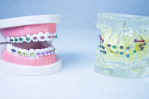 Model Denture Metal Orthodontics People — Stock Photo, Image