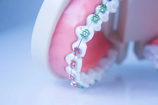Modelo Prótesis Dental Con Ortodoncia Metálica Hay Gente —  Fotos de Stock