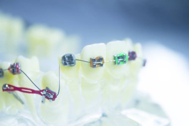 Metal ortodontikli protez. Kimse yok.