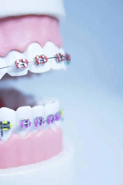 Model Denture Metal Orthodontics People — Stock Photo, Image