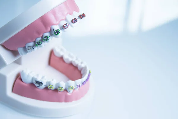 Model Denture Metal Orthodontics People — Stock Photo, Image