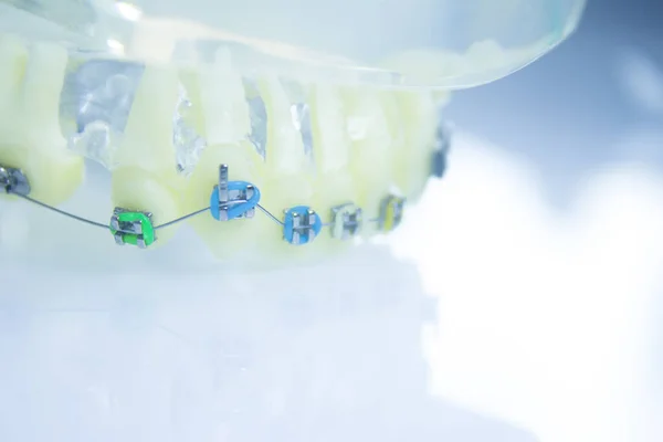 Modelo Prótesis Dental Con Ortodoncia Metálica Hay Gente — Foto de Stock