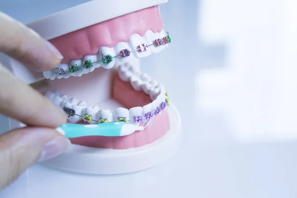 Modelo Prótesis Dental Con Ortodoncia Metálica Hay Gente — Foto de Stock