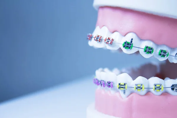 Model Denture Metal Orthodontics People — Stock Photo, Image