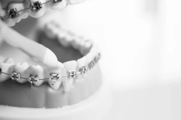 Model Protezy Metalową Ortodoncją Żadnych Ludzi — Zdjęcie stockowe