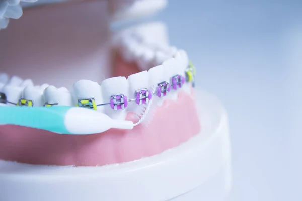 Model Denture Metal Orthodontics People — Stock Photo, Image