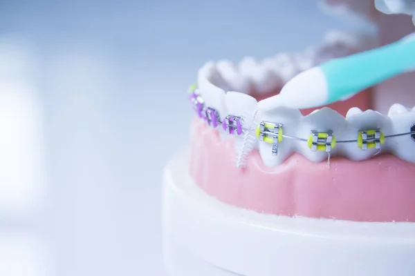 Modelo Prótesis Dental Con Ortodoncia Metálica Hay Gente — Foto de Stock