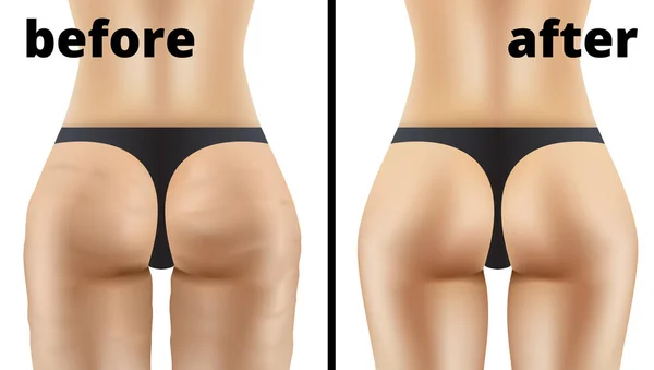 Anticelulite Ass Massagem antes e depois da ilustração —  Vetores de Stock