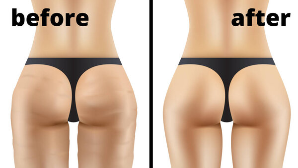 Anticellulite Ass Massage Before And After Illustration