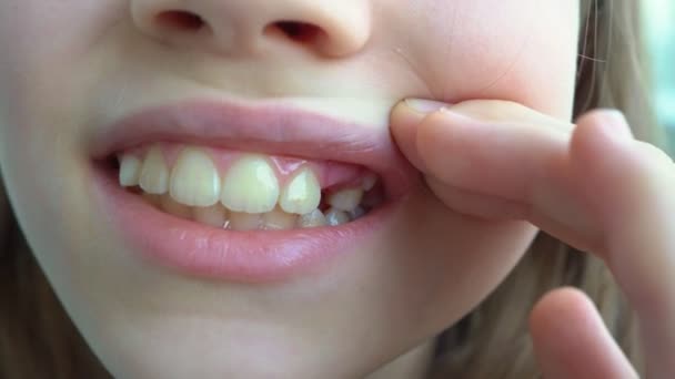 Adult teeth coming in front of child baby teeth — Stock Video