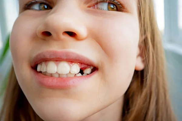 Dospělí zuby přichází před dítě dětské zuby — Stock fotografie