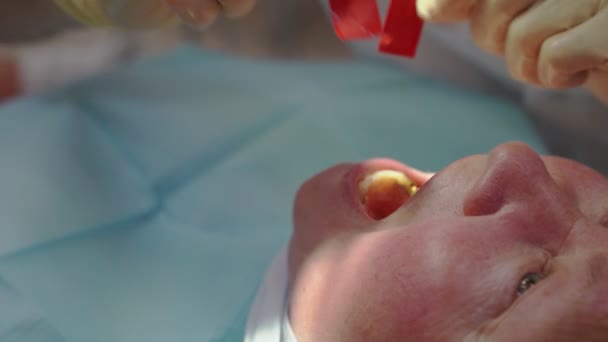 Руки стоматолог примерить на пациенте зубного протеза — стоковое видео