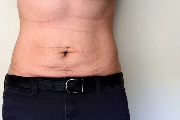 Woman belly with stretch marks and scars