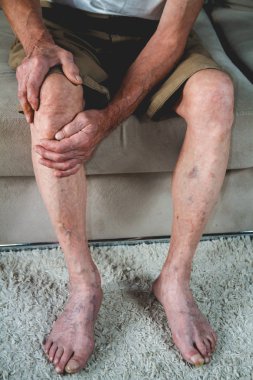 Yaşlı bir ihtiyarın bacak ve dizlerinde ağrı var.