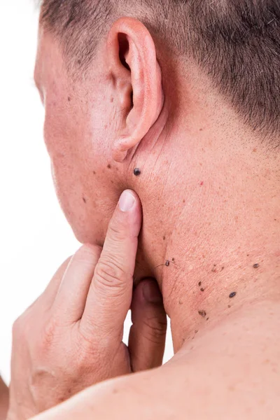 Finger embrace mole on neck and shoulder of Asian male — Stock Photo, Image