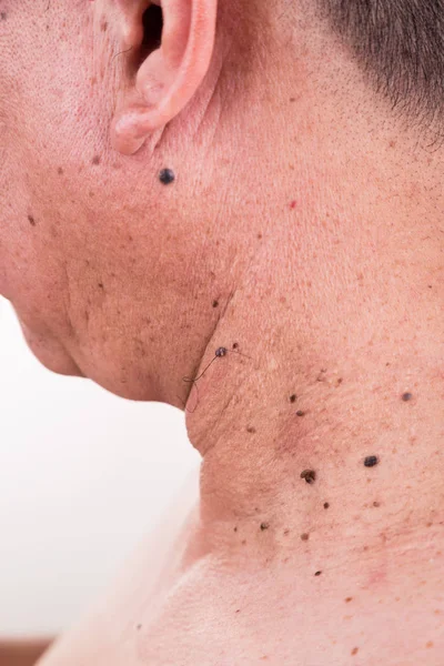 Multiple mole on neck and shoulder of Asian male — Stock Photo, Image