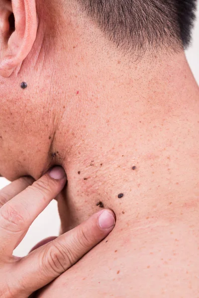 Finger embrace mole on neck and shoulder of Asian male — Stock Photo, Image