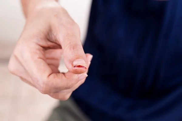 Pijnlijke duim vinger met gesneden blessure — Stockfoto