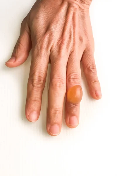 Finger with painful inflammed fluid-filled blister — Stock Photo, Image