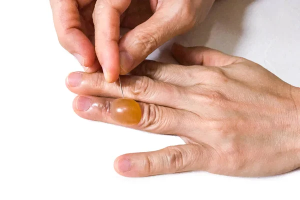 Close-up picando doloroso inflamado líquido blister dedo com sh — Fotografia de Stock