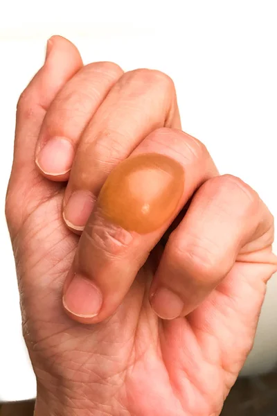Крупный план на пальце с болезненным воспалительным пузырем, наполненным жидкостью — стоковое фото