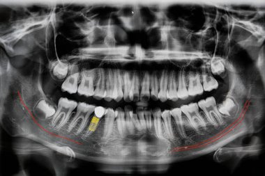 Çene ile dijital röntgen implant diş