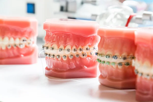 Orthodontics dental braces on teeth model to align teeth