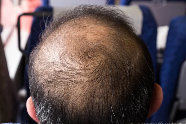 Close-up of balding and thinning hair of man revealing scalp