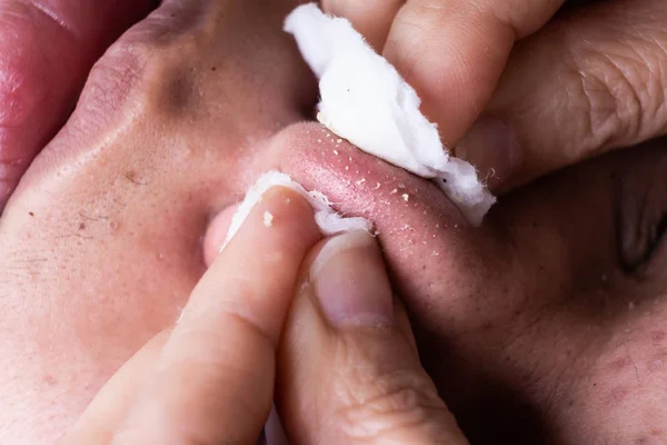 Dedo apertando estalando whiteheads pus espinha forma rosto de adolescente — Fotografia de Stock