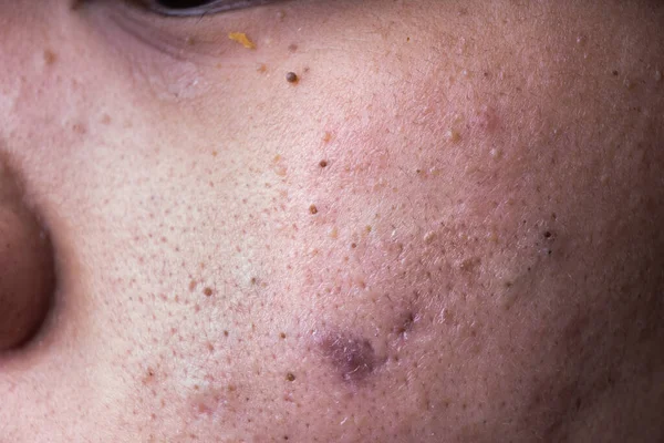 Ugly pimples blackheads on cheek face of teenager — Stock Photo, Image