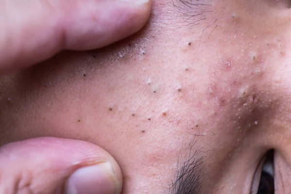 Finger on ugly pimples blackheads on face of teenager — Stock Photo, Image