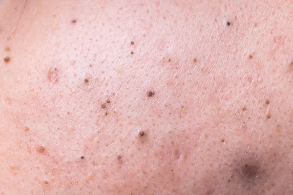 Ugly pimples blackheads on face of teenager — Stock Photo, Image